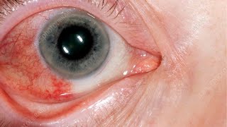 What is Episcleritis Symptoms Treatment Diagnosis Episcleritis vs Scleritis Conjunctivitis [upl. by Remas]