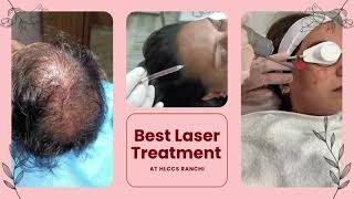 Best Laser treatment at HLCCS RANCHICall now 9334334935 laser skincare beauty laserhairremoval [upl. by Frissell]