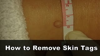 How to Remove Skin Tags  Apple Cider Vinegar For Skin Tag Removal [upl. by Ibib]