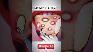 Best Treatment of Tongue infection  ASMR ytshorts youtube [upl. by Htur]