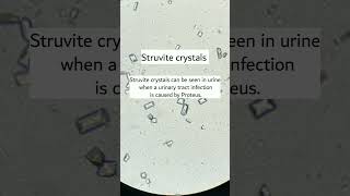 Struvite crystals under microscope seen when UTI caused by proteusmicroscopy urinalysis [upl. by Acireh]