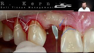 Bifid VIP  Vascularized Interpositional Periosteal [upl. by Salohci]