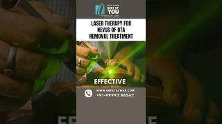 Laser Therapy for Nevus of OTA Removal Treatment  Nevus of OTA Treatment in Delhi  Dr PK Talwar [upl. by Nosilla484]