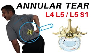 Annular Tear L4L5 L5S1 Disc Bulges [upl. by Nrublim]