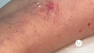 Sclerotherapy Procedure Spider Vein Treatment [upl. by Wendin432]