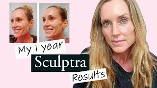 My 1 year Sculptra update with BEFORE amp AFTER Pictures  Is Sculptra worth the it [upl. by Aicenat]