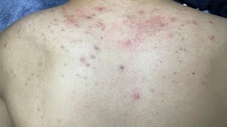 ACNE TREATMENT VU QUYNH MI  Acne On Back FULL [upl. by Eilrebmik]