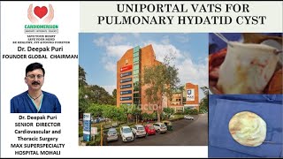 UNIPOTAL VATS FOR PULMONARY HYDATID CYST [upl. by Esekram]