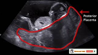 Baby Gender and placenta Positions in pregnancyPlacenta on Ultrasound [upl. by Ella615]