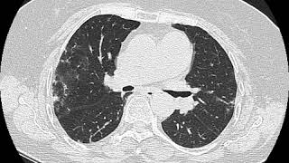 Amiodarone pulmonary fibrosis Ahuja AT et al 2017 Book Essential Radiology [upl. by Dustin725]