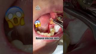 Removal of Infected Tooth [upl. by Ahseiym728]