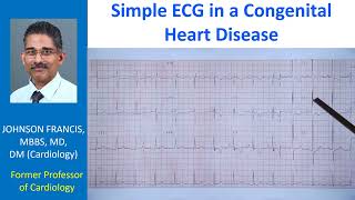 Simple ECG in a Congenital Heart Disease [upl. by Christmann525]