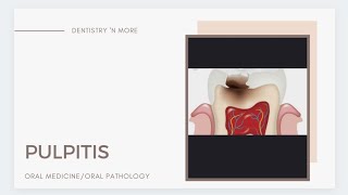 PULPITIS [upl. by Matheson]