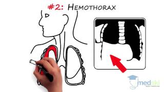 Emergency Medicine  Chest Injuries By Ramesh Reddy MD [upl. by Cain]