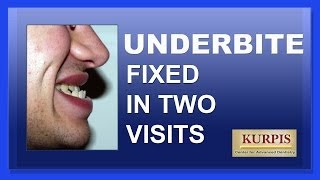 Fix Underbite Without Orthognathic Surgery [upl. by Assyli]