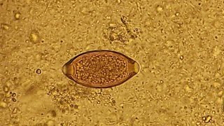 Trichuris trichiura in stool microscopy [upl. by Morley139]