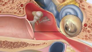 Repair a perforated ear drum using ClearDrum [upl. by Norbert665]