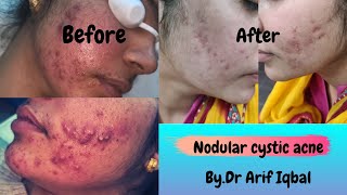 How to treat painful nodular acne  Steroid injection for cystic acne [upl. by Caryn]