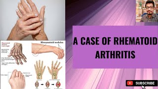 A CASE OF RHEUMATOID ARTHRITIS  DrAbhishekChoudhary [upl. by Ballman]