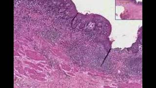 Histopathology EsophagusChronic esophagitis [upl. by Bill]