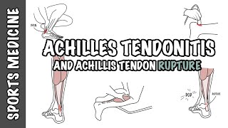 Achilles Tendonitis and Tendon Rupture  Overview [upl. by Nima711]