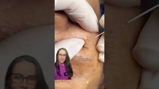 Quistes Milium acne viralvideo facial [upl. by Hayikat]