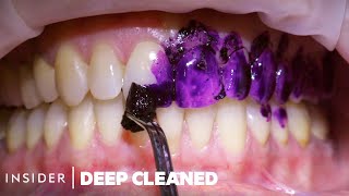 How Teeth Are Professionally Deep Cleaned  Deep Cleaned [upl. by Aivatnuhs]