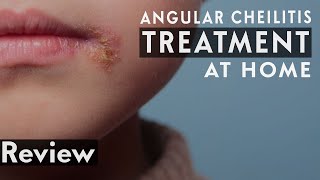 Angular Cheilitis Treatment at Home  Angular Cheilitis Treatment  Angular Cheilitis Home Remedies [upl. by Anires640]