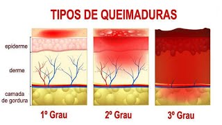 ME QUEIMEI COM AGUA QUENTE COANDO CAFÉ O QUE FAZER NESSAS HORAS PARA DIMINUIR A DOR [upl. by Oos]