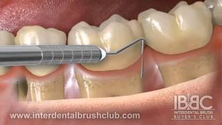 Periodontal disease causes and treatment [upl. by Sadiras]