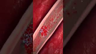 heart attack medical animation medicaleducation doctor acs [upl. by Gurango142]