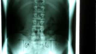 Gohl Clinic of Chiropractic  How we use xrays by Carlsbad Chiropractor [upl. by Mandelbaum868]