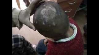 Scalp Eczema cured By Homeopathy DrRavi Singh [upl. by Terencio]