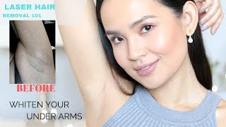 The TRUTH About Laser Hair Removal My Experience  How to lighten underarms [upl. by Capello]