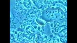 7 Kyste amibe trophozoites amibes globules blancs et Trichomonas dans les parodontites [upl. by Wendin]