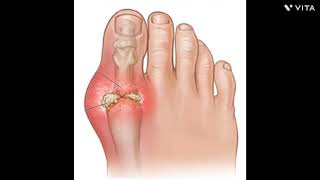 gouty arthritis and rheumatoid arthritis  osteoarthritis amp rheumatoid arthritis [upl. by Justen]