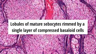 Pathology of Sebaceous Hyperplasia by Dr Sampurna Roy MD [upl. by Ivetts]