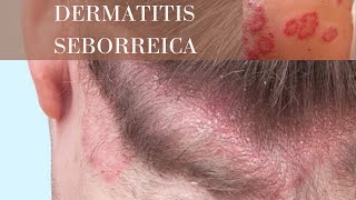 Tratamiento para la caspadermatitis seborreica l Mercí Natura [upl. by Klockau]