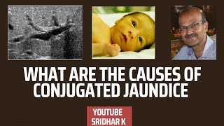 What are the causes of conjugated jaundice neonatalcholestasis conjugatedjaundice biliaryatresia [upl. by Maltz]