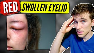 Swollen Eyelid causes amp solutions  Eye Doctor Explains [upl. by Goldi]