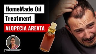 Effective Home Remedy for Alopecia Areata DIY Oil Treatment  Panchayu [upl. by Butte230]