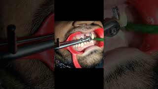 Dental Implant procedure dentist indiandentist dentistry [upl. by Anrak]