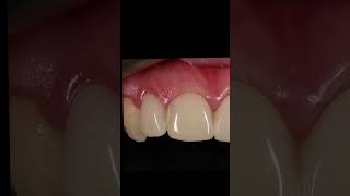 Replacing old ceramic crowns [upl. by Ahsyia]