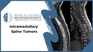 Intramedullary Spine Tumors [upl. by Kauslick722]