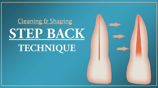 Step Back Technique  Root Canal Treatment [upl. by Stevy]