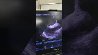 Echocardiography finding of elderly patient with asdpfo [upl. by Alithia73]