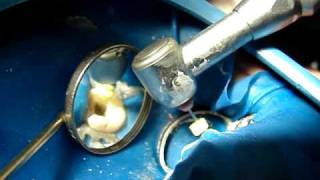 INSTRUMENTAÇÃO OSCILATÓRIA EM ENDODONTIA [upl. by Thadeus]