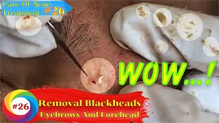 Pimples Blackheads Between Eyebrows And Forehead  Care Of Acne Treatment 25 [upl. by Ireva]