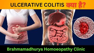 quotUlcerative Colitis Understanding Homeopathic Treatments and Effective Managementquot [upl. by Triny122]