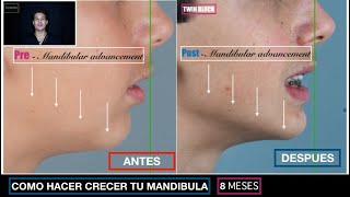 COMO HACER CRECER LA MANDIBULA  ANTES  DESPUES Caso clínico de TWIN BLOCK 8 meses [upl. by Leitnahs98]